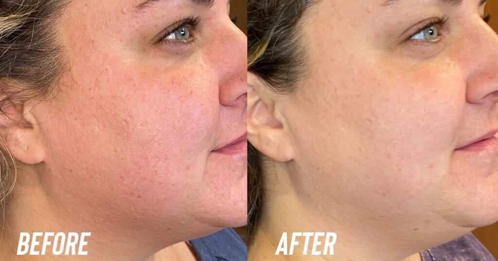 before and after IPL for redness, hyperpigmentation, brown spots in grand ledge, by kylie brooks a licensed aesthetician.