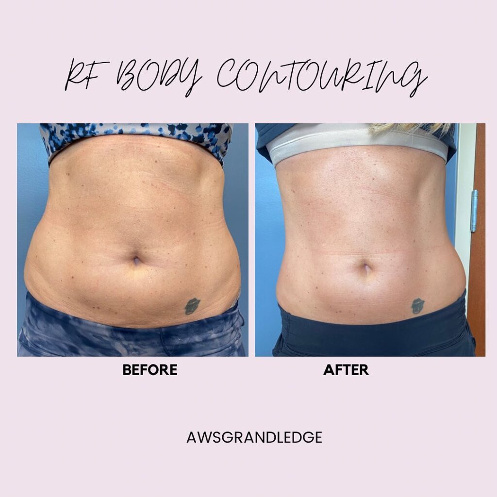 RF Body Contouring AWS Medspa Grand Ledge
