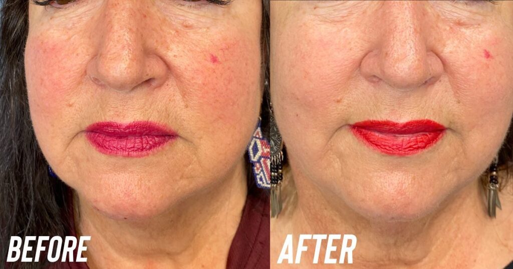 1540 fractional laser resurfacing in grand ledge mi, for acne scarring, and wrinkles, redness and large pores by kylie brooks a licensed aesthetician.